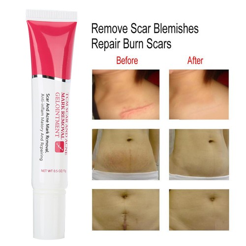 TYJR Scar Removal Cream Face Body Repair Gel Skin Repair Dark Spot Cream 15 AU - Picture 7 of 12