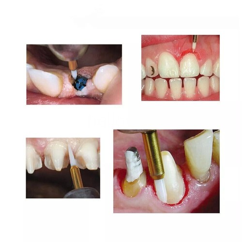 Dental Surgical Ceramic Soft Tissue Trimmer Bur Gingival Retraction Drill 23mm - Picture 3 of 8