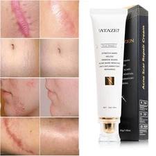 For Surgical Burns C-Section Scar Stretch Marks Keloids Medical-grade Scar Cream