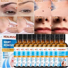 6/10X Wart Remover Liquid Skin Tag Mole Remover Eliminate Feet Corn Wart Removal