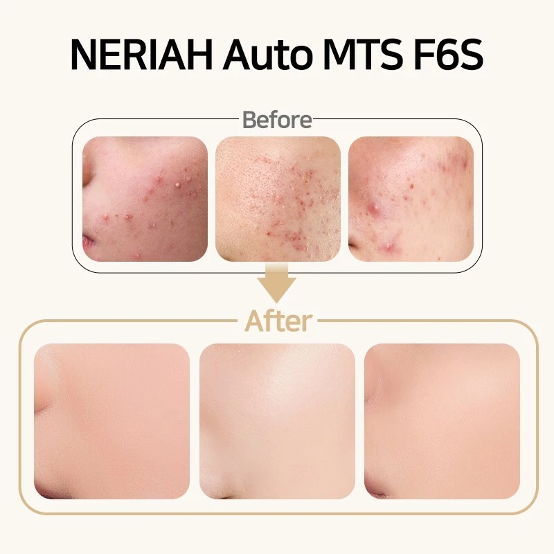 [Neriah] Auto MTS F6S Micro Needle Roller Skin Care Tool Beauty Massager - image 3 of 4