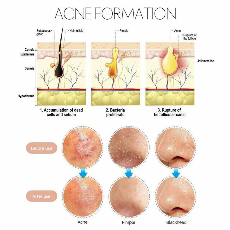 Acne Needle Blackhead Remover Pimple Blemish Comedone Extractor Tweezer Tool Kit - Image 2 of 4