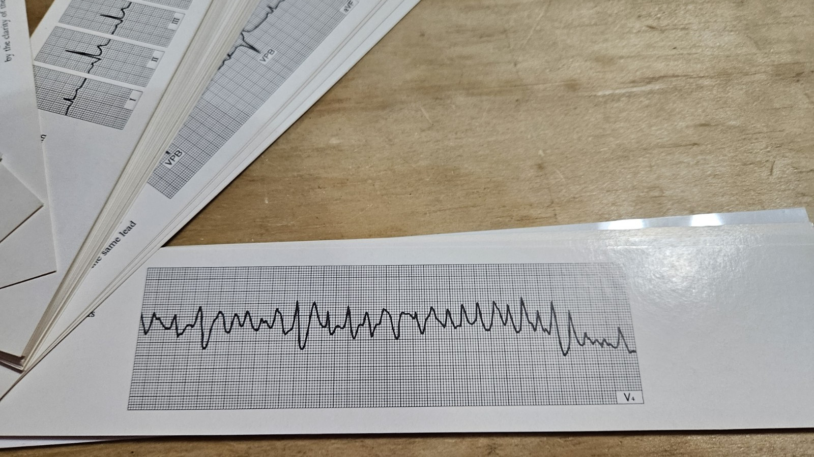 Vintage MERCK SHARP &DOHME THE ELECTROCARDIO GUIDE REPRESENTATIVE ECG CONDITIONS