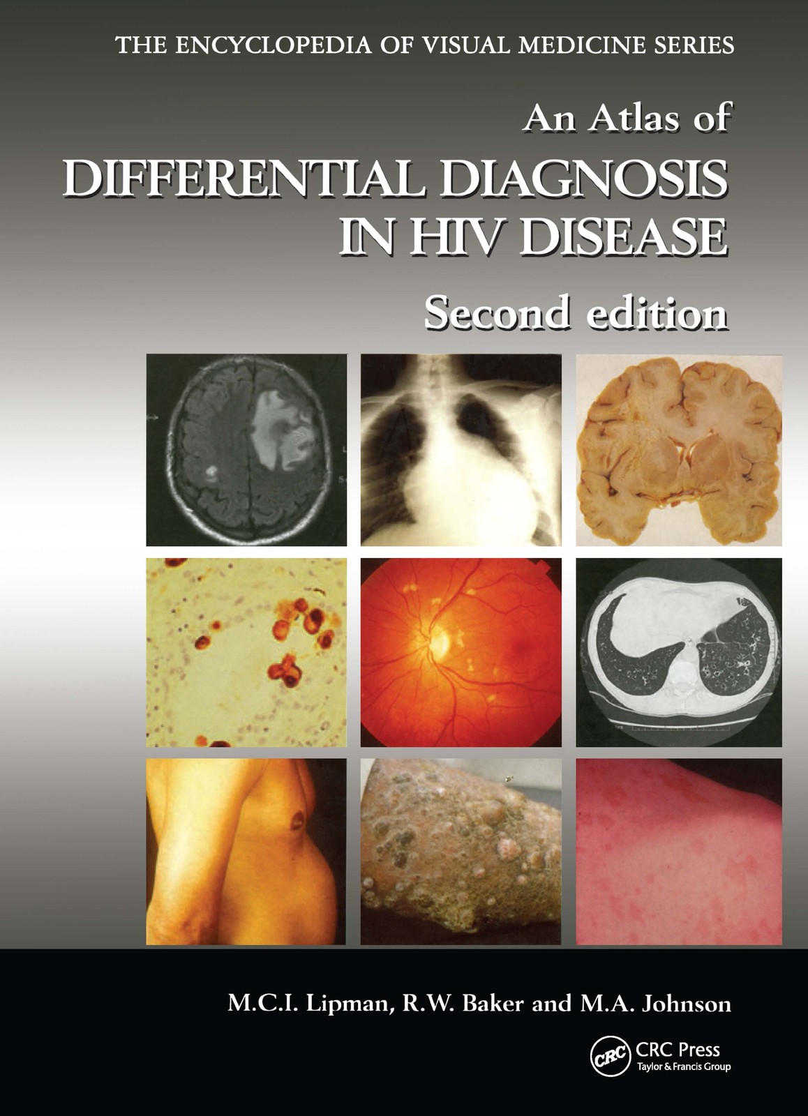 Atlas of Differential Diagnosis in HIV Disease - 2nd Edition