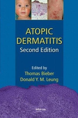 Atopic Dermatitis, Second Edition
