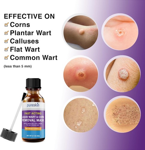 Quemar Verrugas Para Quitar Mezquinos Remedio Remover Quitador De Verrugas