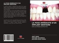 Amit Mani (U. A.) | LA Pose ImmÉDiate D'un Implant Dentaire | Taschenbuch (2021)