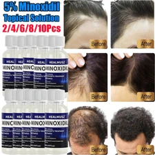 Minoxidil 5% Topical Solution for Men Hair Regrowth, Reactivates Hair Follicles