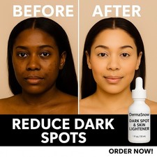 Dark Spot Remover   Melasma Corrector Serum - Ultra Brightening Fade Treatment