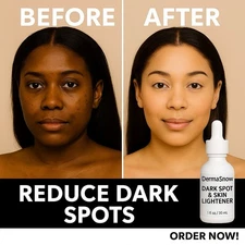 Dark Spot Remover – Melasma Corrector Serum - Ultra Brightening Fade Treatment