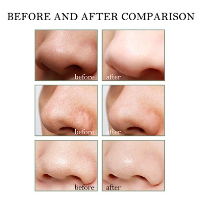 Blackhead Remover Tools -15g Blackhead Creamwith 40Pcs Blackhead Pore Strips