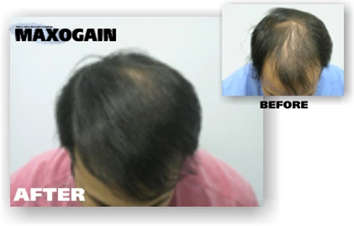 Mens Minoxidil 5% Maxogain 4in1 Topical Advanced 6x60 08/2027 FREE SHIPPING - Image 4 of 4