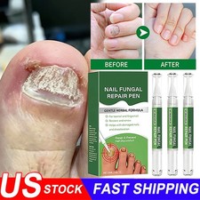 2026 5Set Fungus Treatment Pen, Fungi Nail Fungus Remover New USA