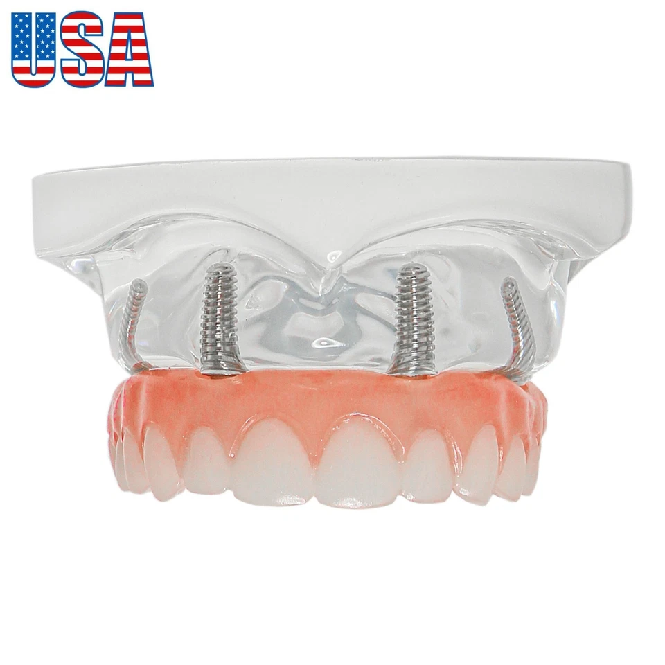 US Dental Overdenture Restoration Teeth Model Upper/Lower Jaw Type With 4/6Screw - Image 2 of 4