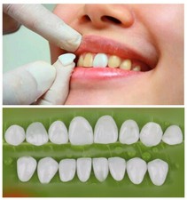 Anterior Teeth Veneer Dental Tooth Whitening Veneers SL Ceramic 3Size 12Position