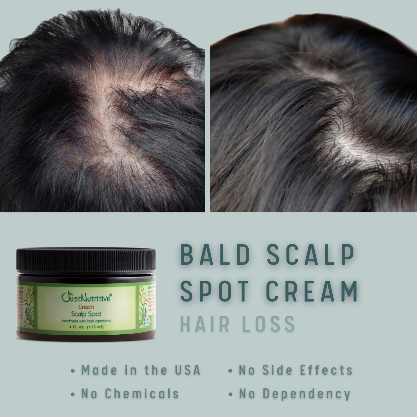 Bald Scalp Spot Cream / Bald Spot Treatment