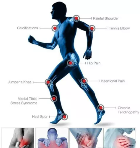 ED Shockwave Therapy Machine Stoßwellentherapie Gerät Stoßwellen Therapiegerät - Bild 5 von 21