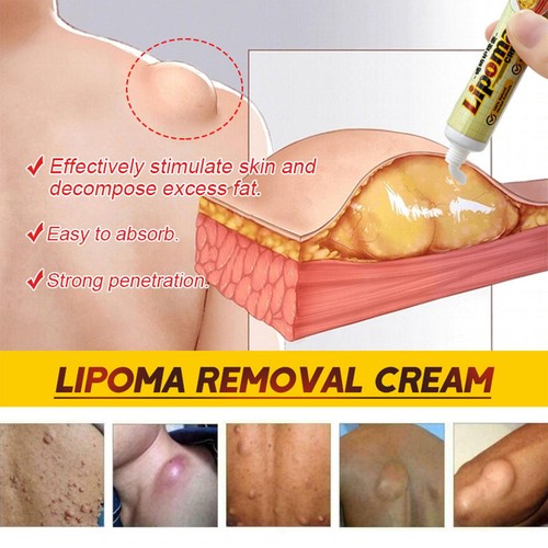 Lipom-Creme, sichere Inhaltsstoffe, pflanzliche Lipom-Fettklumpen-Entfernungscre - Photo 11/12