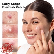 TKTK 265 Dissolving Pimple Patches Salicylic Acid Acne Stickers 18 Ct