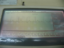 SIEMANS BURDICK E560 ELECTROCARDIOGRAPH WITH STRESS OPTION AND PATIENT CABLE