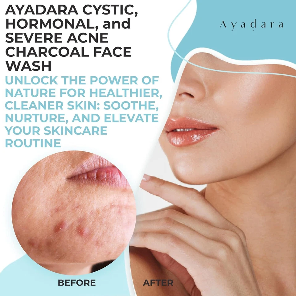 Ayadara Cystic, Hormonal & Severe Acne Charcoal Face Wash, with Sulfur, 200 Uses - Image 2 of 4