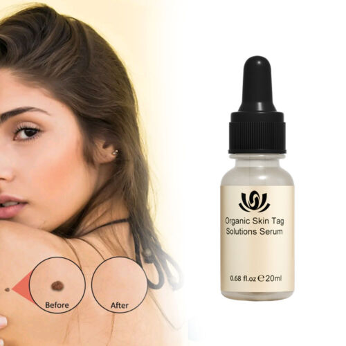 12 Hours Wart Remover Skin Tags Mole Remover Eliminate Foot Corn Wart . - Picture 11 of 12