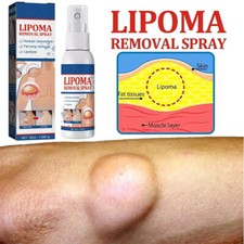 50ML Lipomheilung Reduction Spray, Instant LumpFree Lipoma Removal Spray USA Hot