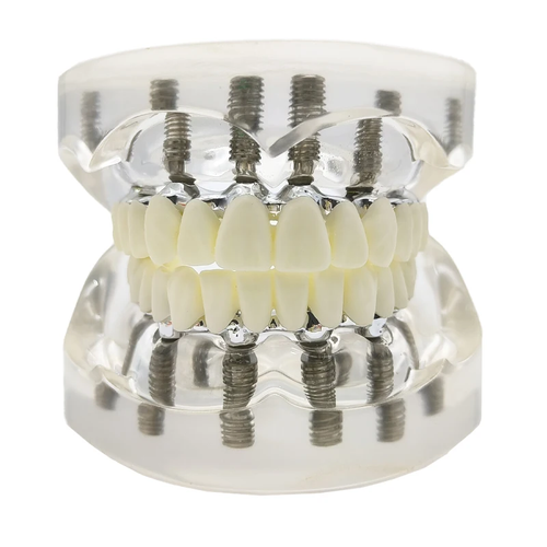 Modelo de implante dental mandíbula superior inferior 6 implantes modelo de restauración de sobredentaduras postizas - Imagen 2 de 10