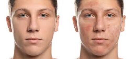 Anti Acne Cream Mask & a Free Cleanser, Herbal Salicylic Acid to Remove Oil Acne