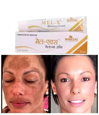 Wheezal Mel-X melasma Cream (25g) for skin pigmentation like melasma, chloasma