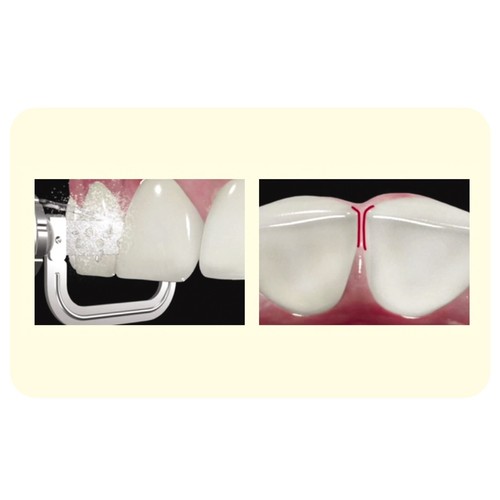 Osung Riduzione Smalto Interprossimale (IPR) Bordo Dritto Diamante Strisce Ortho - Foto 2 di 4
