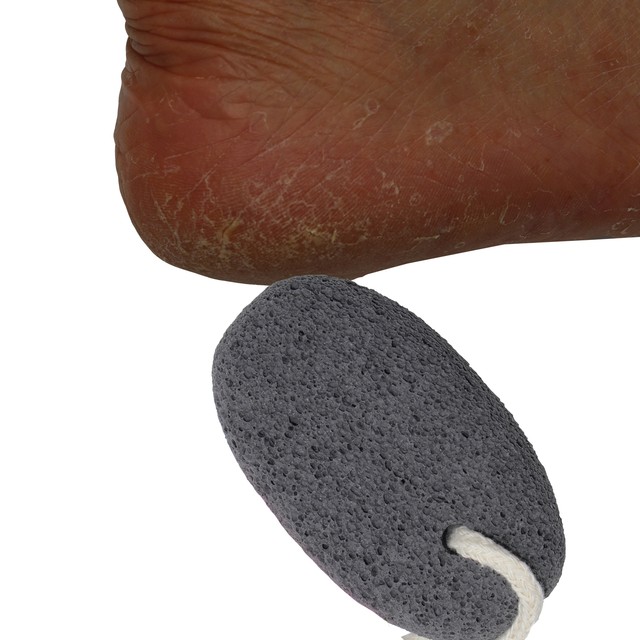 Exfoliating foot Heel Dead Skin Cutin Keratin Remover Pumice Stone Exfoliator eBay