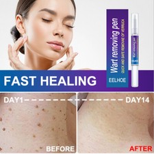 5ml 12 Hours Unisex Wart Remover Pen Eliminate Foot Corn Warts Skin Tag Remover