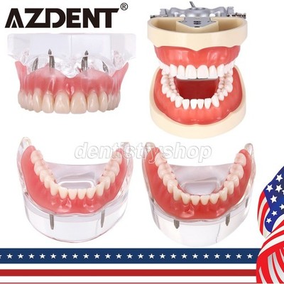 Kilgore NISSIN 200 Type Dental Typodont Model/Implant Denture Restoration Model