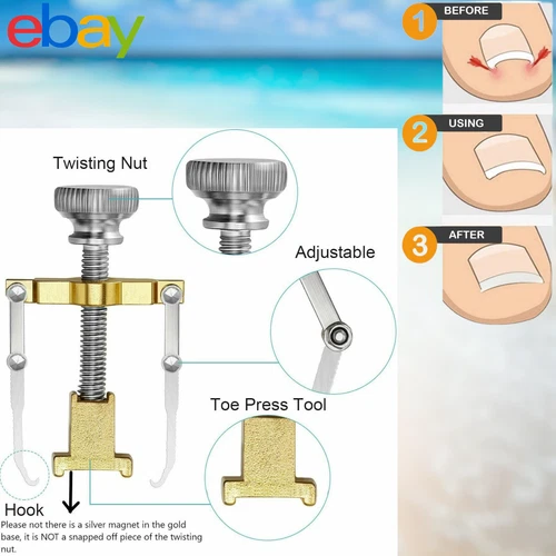 Ingrown Toe Nail Corrector Tool Ingrowing Toe Nail Clamp Straightener Feet Foot - Picture 1 of 15