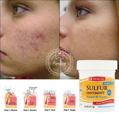 sulfur ointment for acne