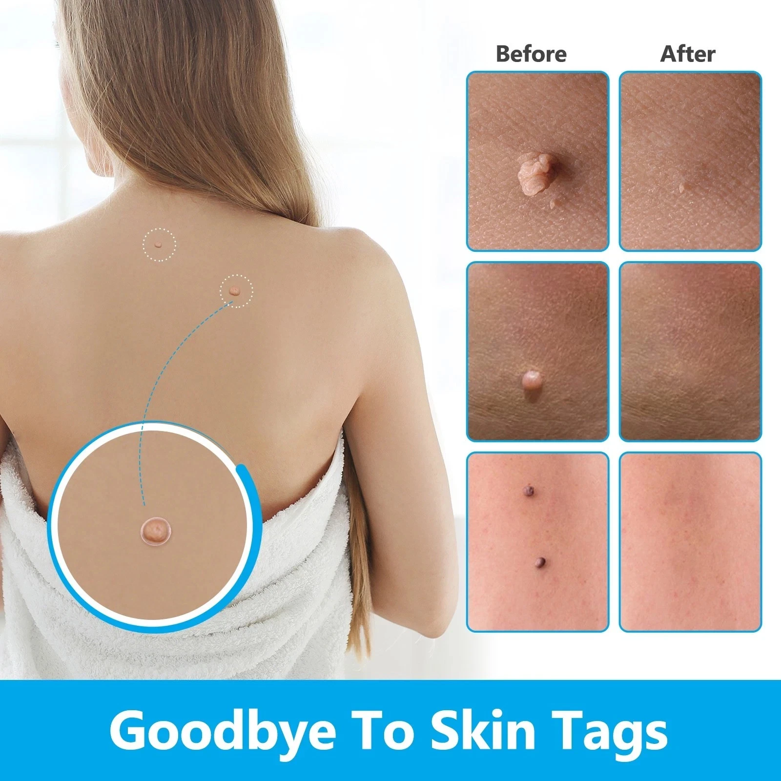 Skin tag removal application example