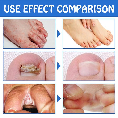 2025 Anti Fungal Microcapsule Socks Treatment Toenail Therapy Sock Foot Care UK- - Picture 10 of 13