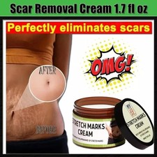 Scar Removal Cream Skin Repair Acne Treatment Fade Stretch Markers Burns NEW