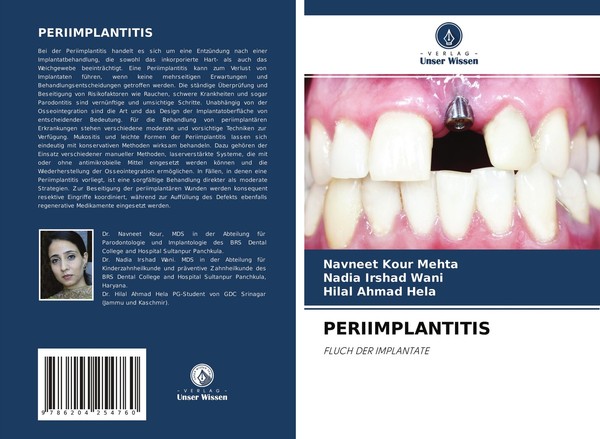 Periimplantitis Navneet Kour Mehta-image