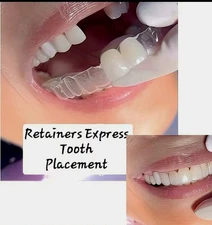 Retainer With Teeth, Affordable Way To Fill In Your Smile, with 1-3 Teeth added.