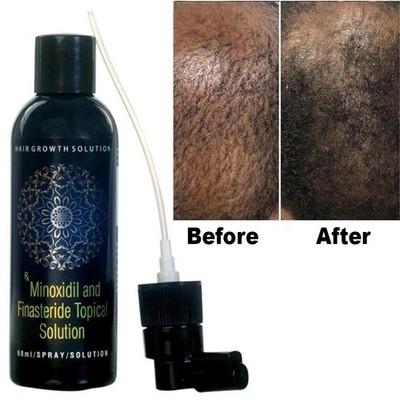 1PCS Extras Strength Mens Regrowth Treatment Regain 1Months Hair Growth Solution