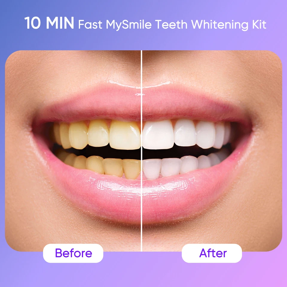 MySmile 35% CP Ultimate Kit de Gel Blanqueador de Dientes con 28X Luz LED 10Min Blanqueador Foto 2 de 4
