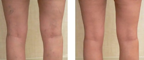 Lux Vitamin K Cream - Eliminate Spider Varicose Veins Scars Rosacea Capillaries - Picture 3 of 8