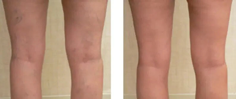 Lux Vitamin K Cream - Eliminate Spider Varicose Veins Scars Rosacea Capillaries - Image 3 of 4