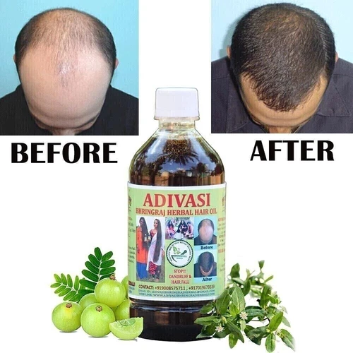 DHT Blocker Hair Loss Oil 3.4 oz, Active Formula For Hair Growth With Biotin