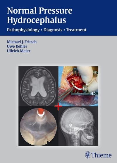 Nph - Normal Pressure Hydrocephalus: Pathophysiology - Diagnosis - Treatmen-image