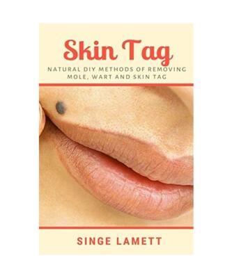 Skin Tag: Natural DIY Methods of removing Mole, Wart and Skin Tag, Singe Lamett