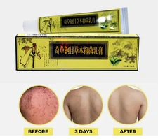 Cream Psoriasis Eczema Treatment Dermatitis Skin for Body Relief Natural*