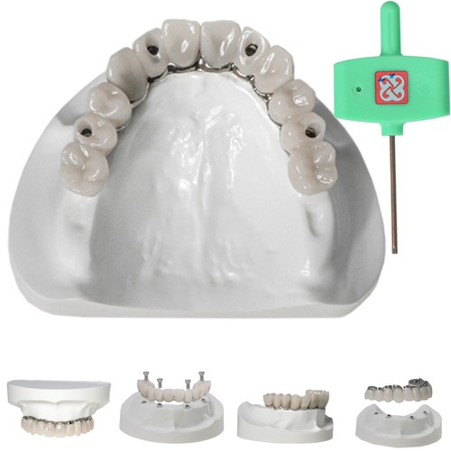 Demo Overdenture All On 4 & All On 6 treatment Dental Implant Model 4/6 Screws - Picture 17 of 83